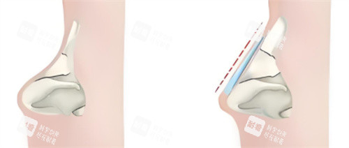 隆鼻超肋材料對(duì)比