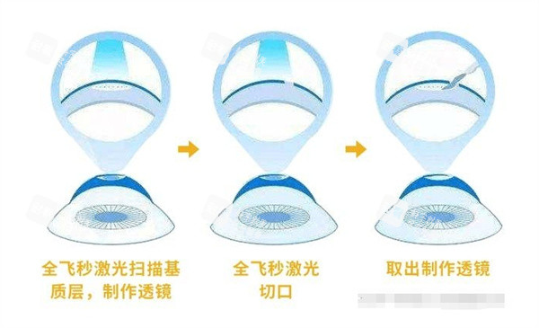 全飛秒激光治眼睛切口