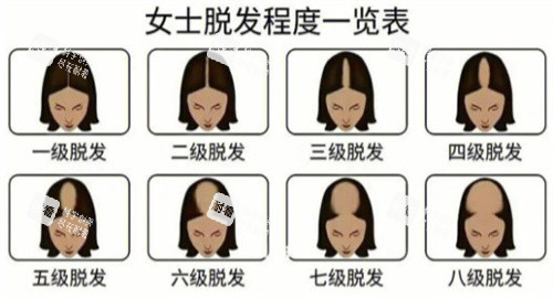 脫發(fā)等級(jí)