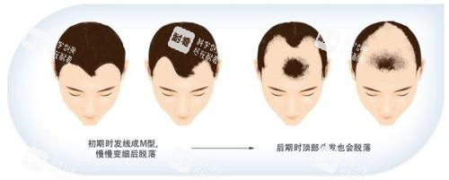 脫發(fā)步驟動(dòng)畫演示圖