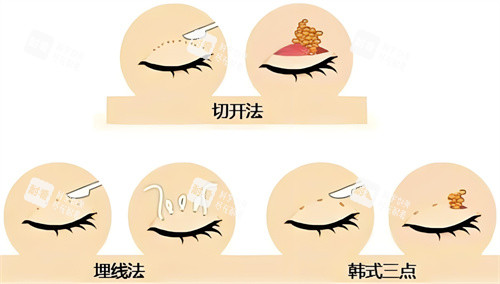 雙眼皮方法對(duì)比圖