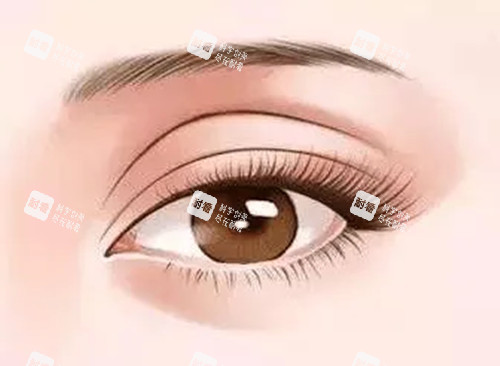 雙眼皮修復(fù)卡通示意圖