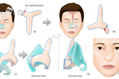 鼻再造手術過程