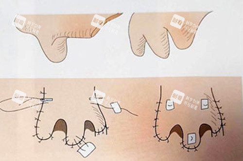 鼻再造術后變化