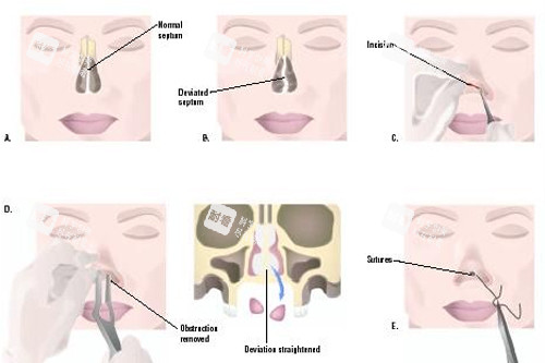 鼻再造手術的過程圖解