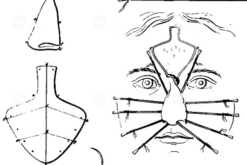鼻再造手術部位
