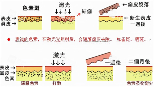 激光祛斑過程