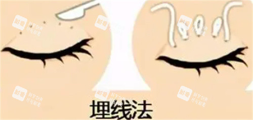 雙眼皮埋線怎么做的