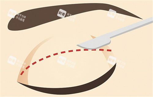 雙眼皮的切口切線