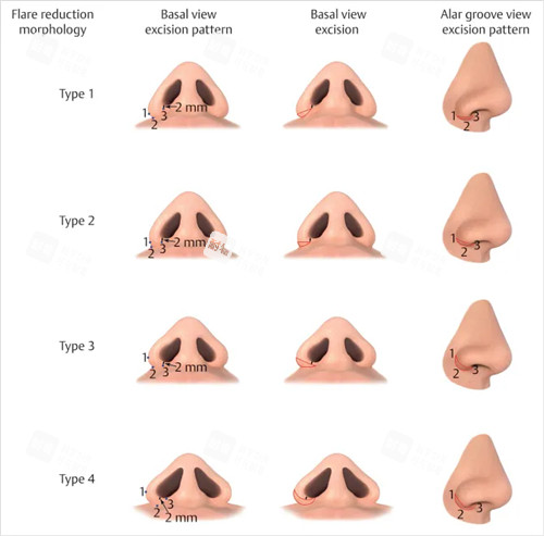 不同鼻子縮小鼻翼對(duì)比圖