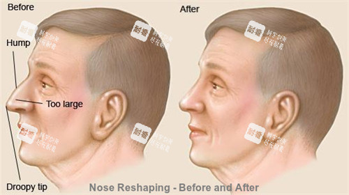 正常鼻子和過長的鼻子矯正對(duì)比