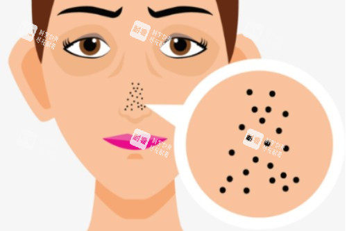 鼻子毛孔粗大卡通圖