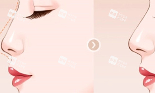 墊鼻子的前后對(duì)比動(dòng)畫圖