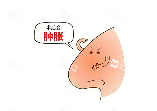 隆鼻術后腫脹動畫圖