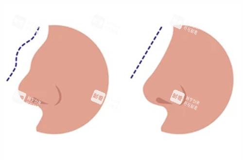修復(fù)失敗鼻子前后對比圖