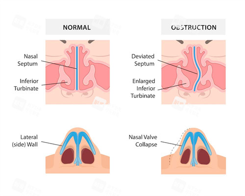 扭曲鼻子的修復(fù)對比圖