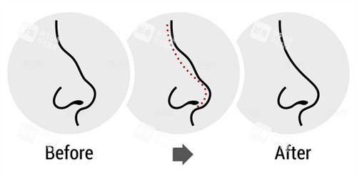 駝峰鼻子的改變過程圖