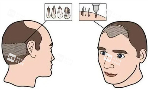 發(fā)際線植發(fā)