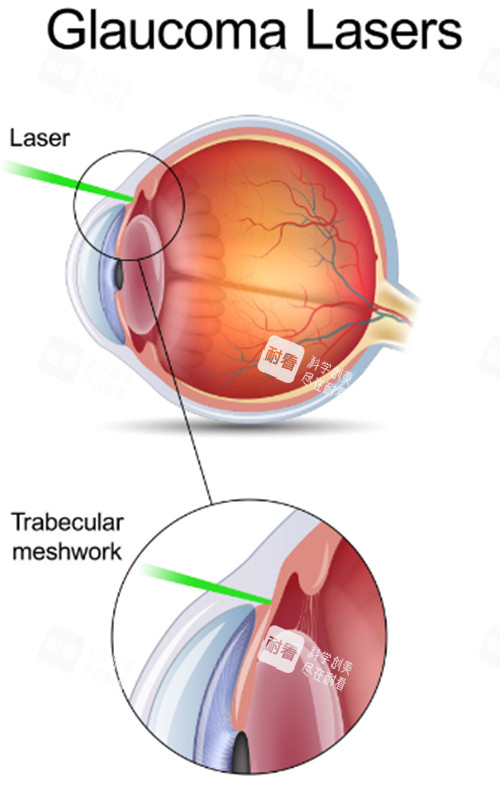 青光眼出現(xiàn)的問題