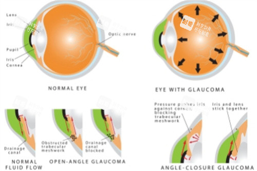 青光眼結(jié)構(gòu)圖