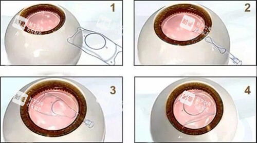 近視矯正人工晶體植入漫畫示意圖