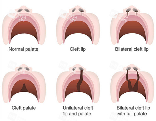 唇裂修復(fù)類型