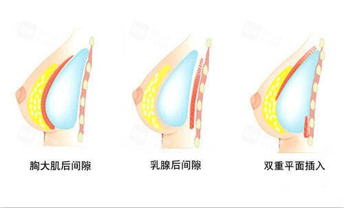西安藝星竇璽院長豐胸技術(shù)好嗎？真實病例+價格+預約方式全解析