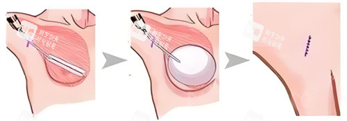 假體隆胸術(shù)圖