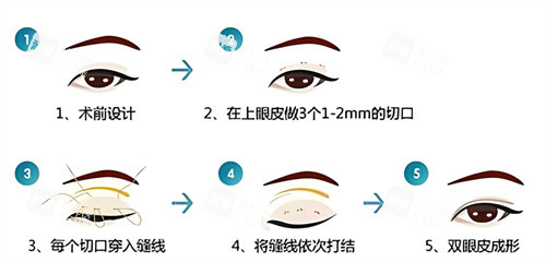 雙眼皮三點術(shù)過程原理