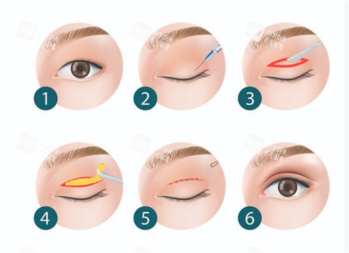 雙眼皮手術(shù)過(guò)程圖 雙眼皮手術(shù)過(guò)程圖