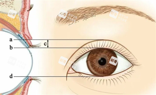 PARK法雙眼皮素材 PARK法雙眼皮素材