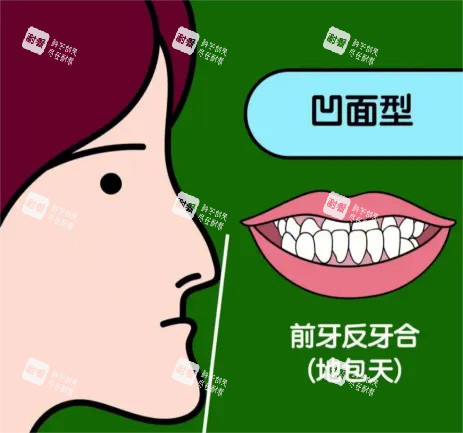 地包天漫畫(huà)示意圖