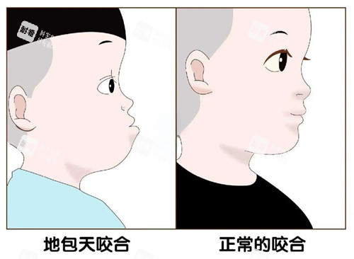 地包天和正常對(duì)比圖