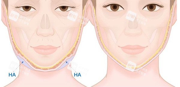 饅化臉改善前后變化