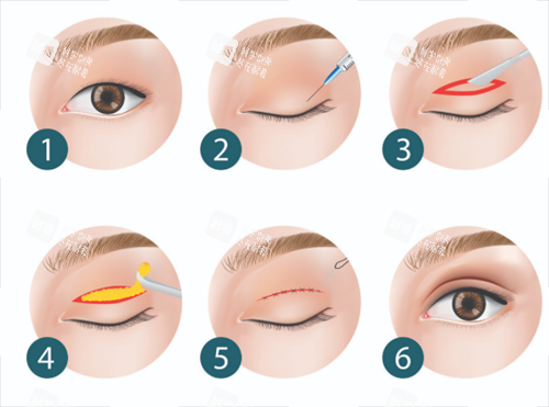 雙眼皮步驟 雙眼皮步驟