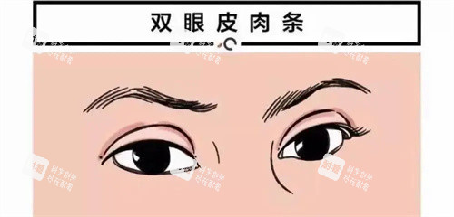 雙眼皮肉條痕圖 雙眼皮肉條痕圖