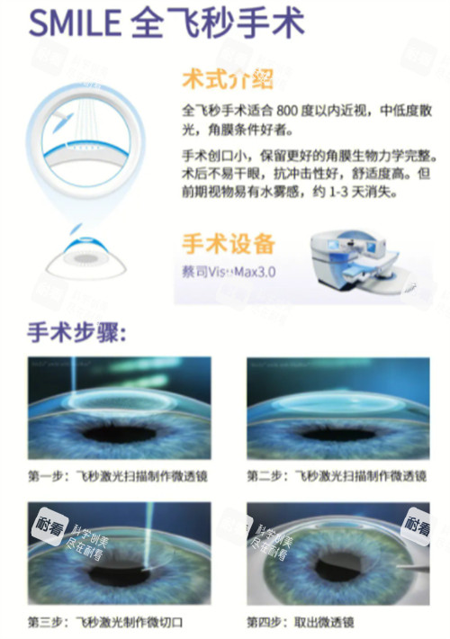 全飛秒近視手術(shù)術(shù)式介紹圖解