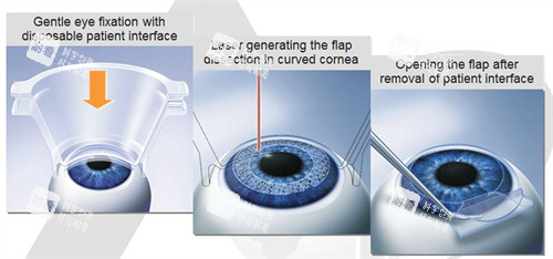 近視手術(shù)制瓣