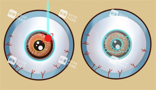 近視手術不同種類的眼球表現(xiàn)