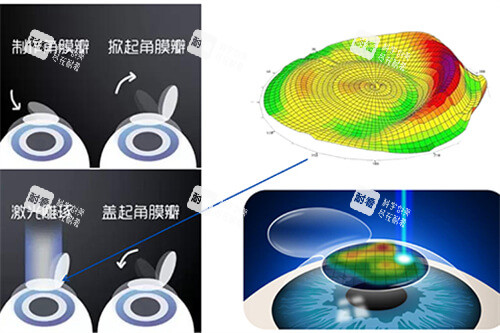 激光近視手術過程示意圖