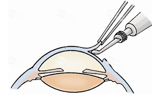 近視手術改善卡通圖