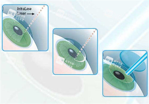 近視手術過程圖解