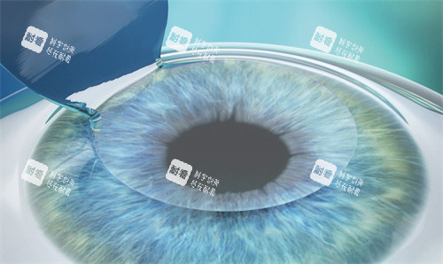 近視手術(shù)制瓣中