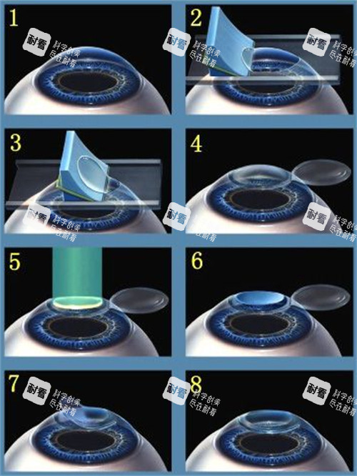 近視手術(shù)的手術(shù)過程