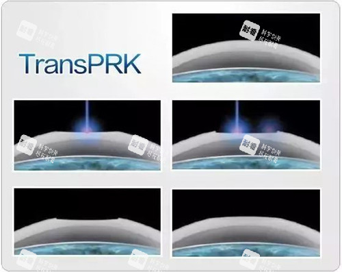 TPRK近視手術(shù)示意圖