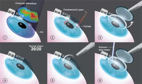 近視手術(shù)的流程圖