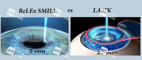 全飛秒近視手術(shù)帶來的切口圖解