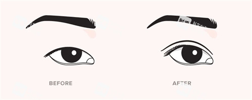 雙眼皮手術(shù)前后對比