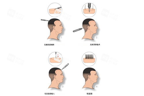 不剃發(fā)植發(fā)示意圖