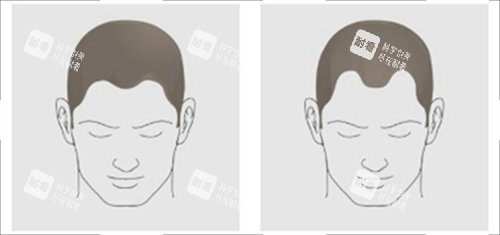 發(fā)際線對比